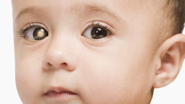 نسبة شفاء سرطان شبكية العين Retinoblastoma