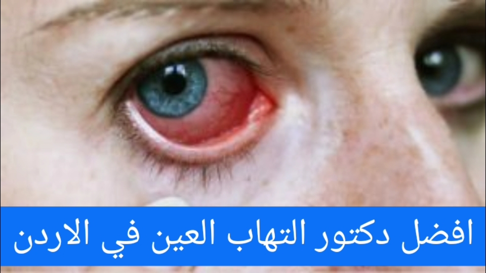 افضل دكتور التهاب العين في الاردن