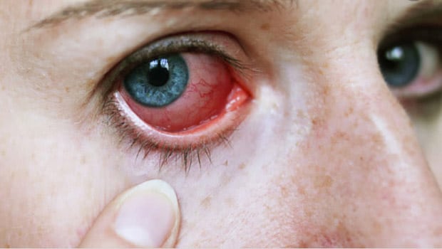 اسباب احمرار العين eye redness
