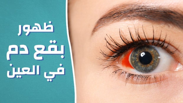 اسباب البقع الحمراء في العين eye doctor near me