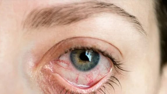 اسباب التهاب العنبية uveitis