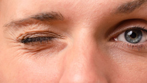 علاج تشنج الجفن blepharospasm botox