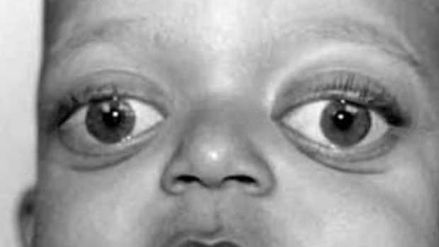 علاج جحوظ العين exophthalmos