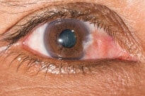 علاج ظفرة العين pterygium surgery