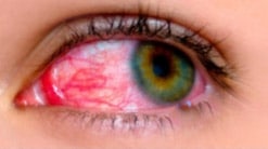 اسباب نزيف الشبكية retinal hemorrhage