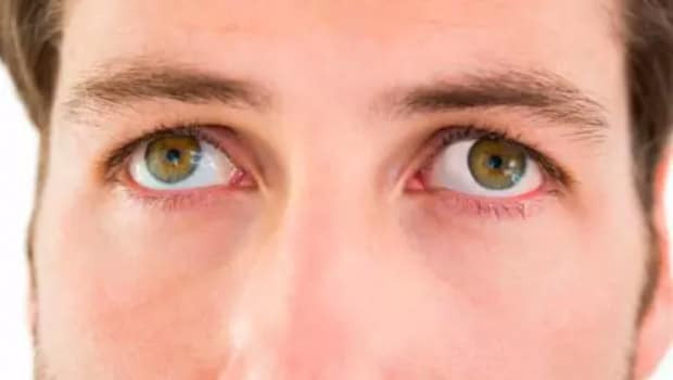 علاج رأرأة العين nystagmus treatment