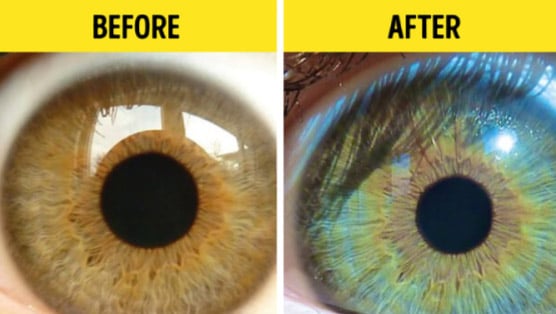 كيفية تغيير لون العيون change eye color surgery