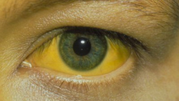 علاج اصفرار العين eye treatment center
