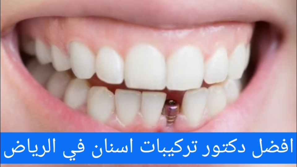 افضل دكتور تركيبات اسنان في الرياض